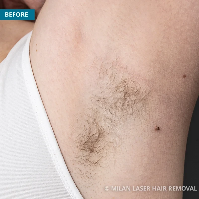 Underarm Before & After Photos of Laser Hair Removal | Milan Laser in South  Bend, IN