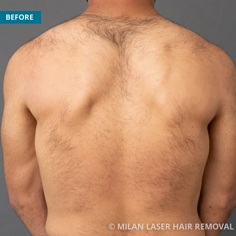 Men's Before & After Photos of Laser Hair Removal | Milan Laser in South  Bend, IN