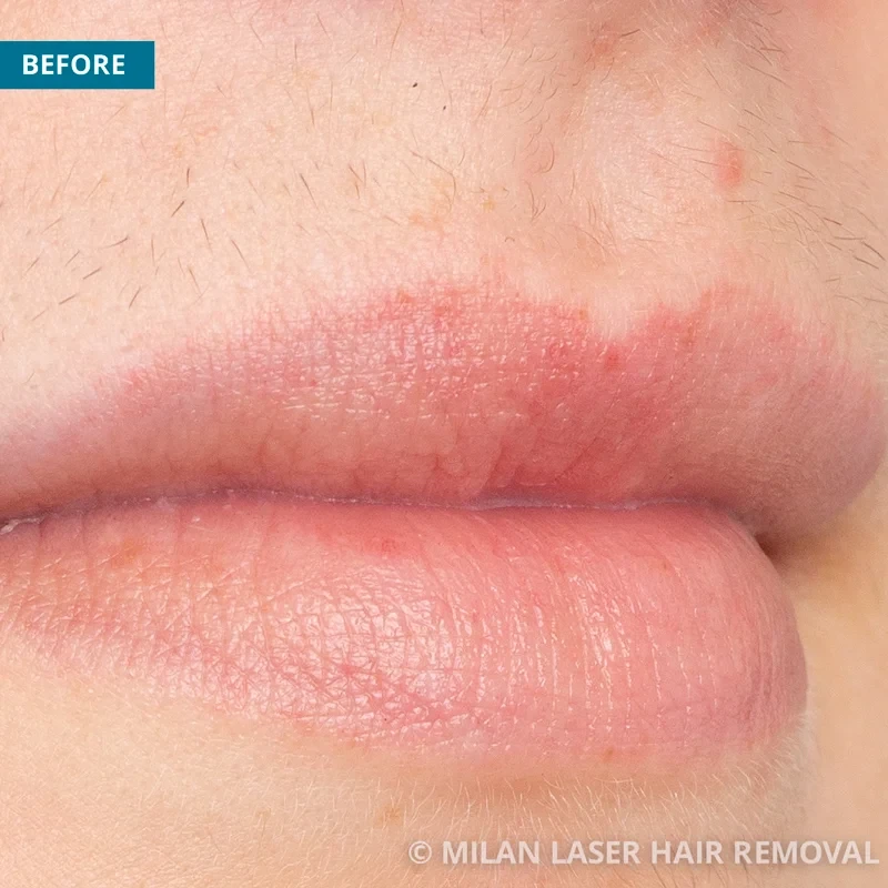 Face Before & After Photos of Laser Hair Removal | Milan Laser in South Bend,  IN