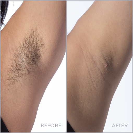 Underarm Laser Hair Removal Photo, Before & After